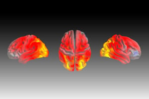 Image of a brain showing shrinkage due to a form of dementia